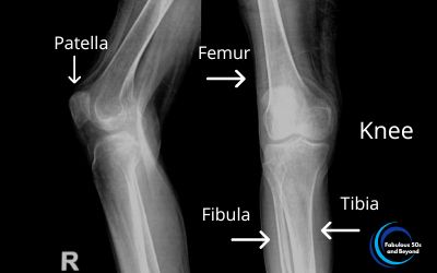 Xray images of both Knees with arrows naming the femur, tibia, fibula, and  patella.