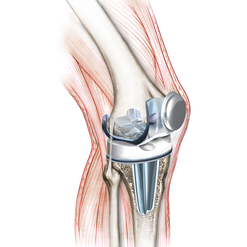 Illustration of a Knee Replacement Joint