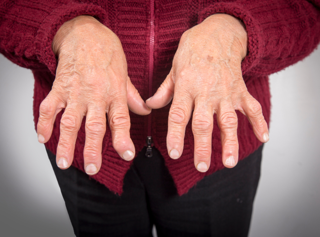 Woman holding her hands out to show Rheumatoid Arthritic hand joints with some of the joints not in alignment